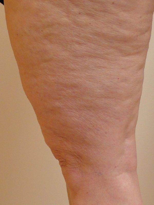 Spider Vein Before & After Photos - Vein Center Orland Park